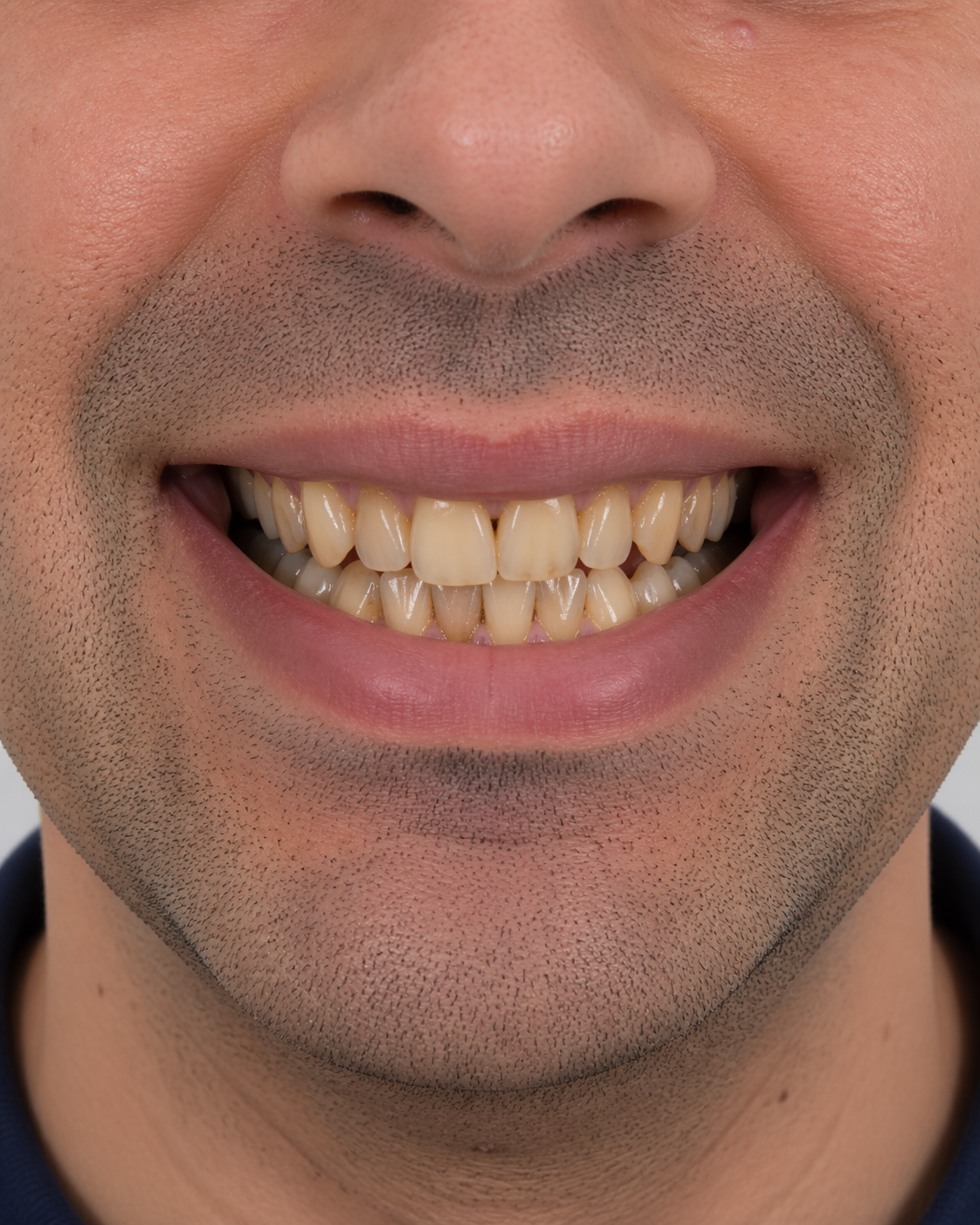 Sonrisa antes del tratamiento